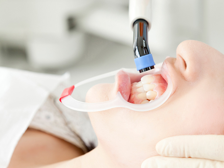 ラミネートベニア