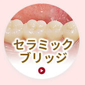 セラミックブリッジ