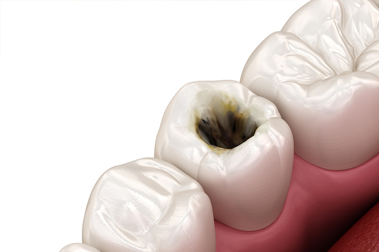 虫歯