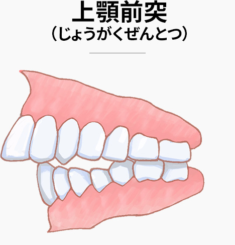 上顎前突 (じょうがくぜんとつ)