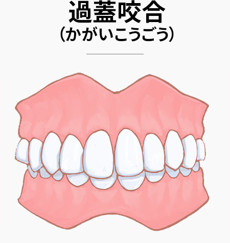 過蓋咬合(かがいこうごう)