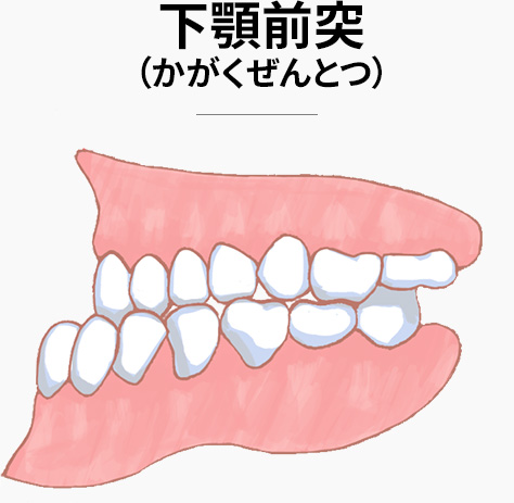 下顎前突(かがくぜんとつ)