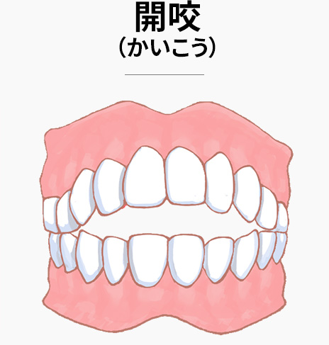 開咬(かいこう)