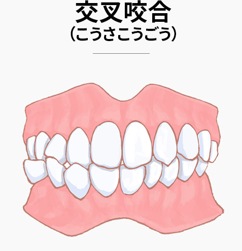 交叉咬合(こうさこうごう)