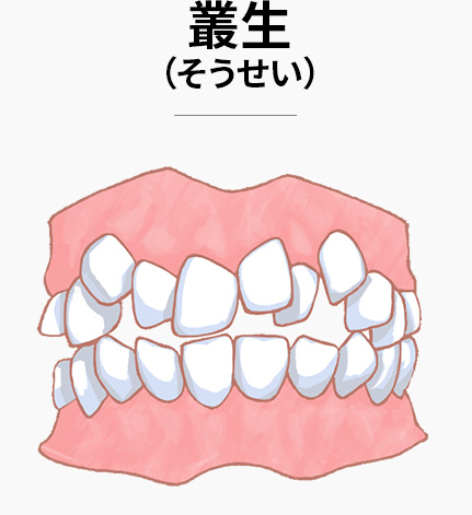 叢生(そうせい)