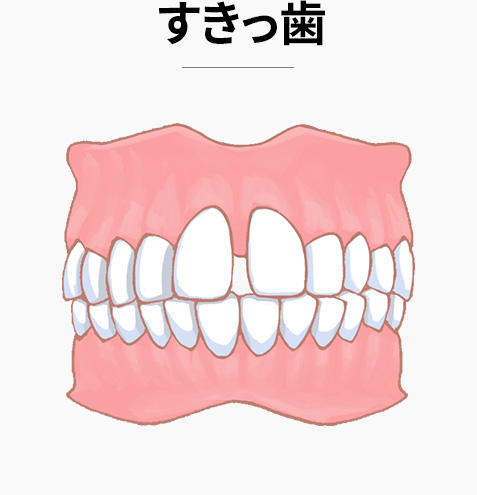 すきっ歯