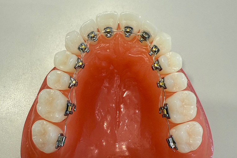 スマイルコンセプトの裏側矯正の特徴