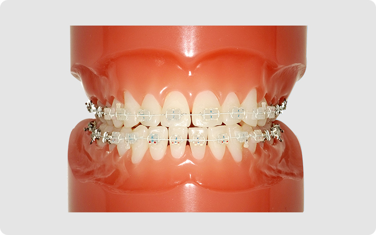 セラミック＋クリアワイヤー