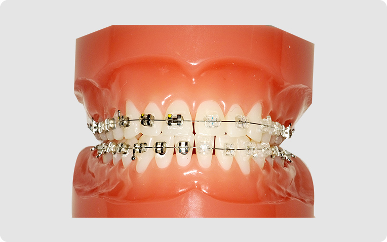 メタルプラスチック