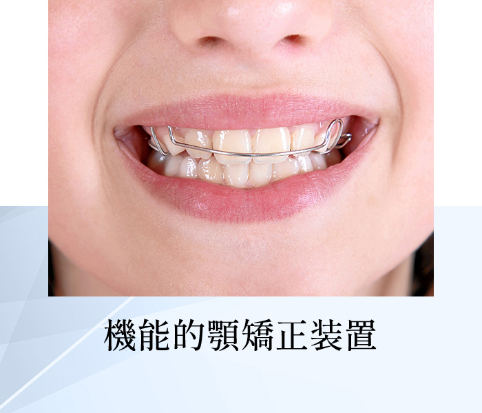 機能的顎矯正装置