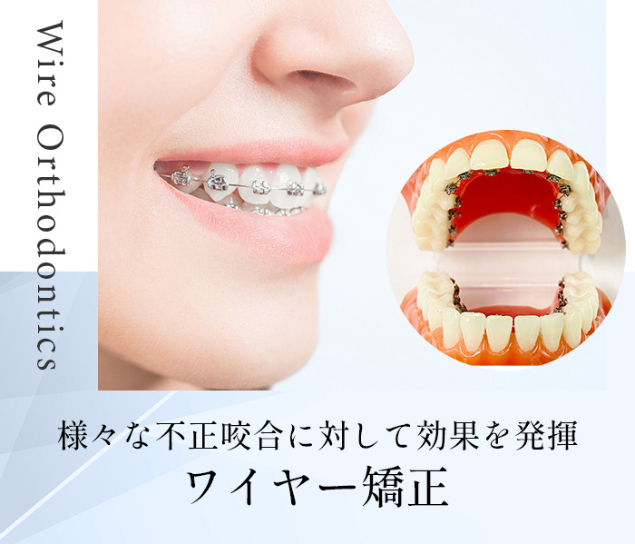 ワイヤー矯正