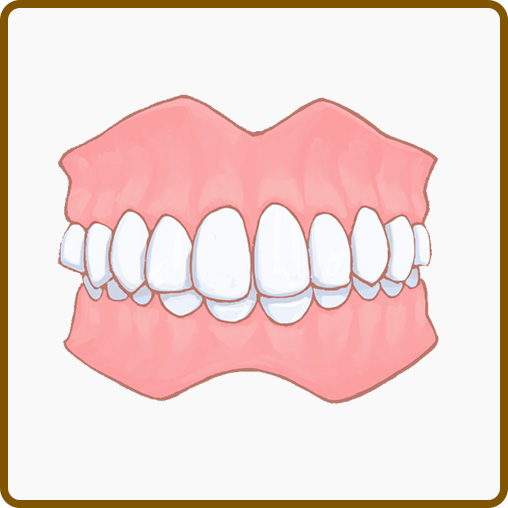 受け口(下顎前突、反対咬合)