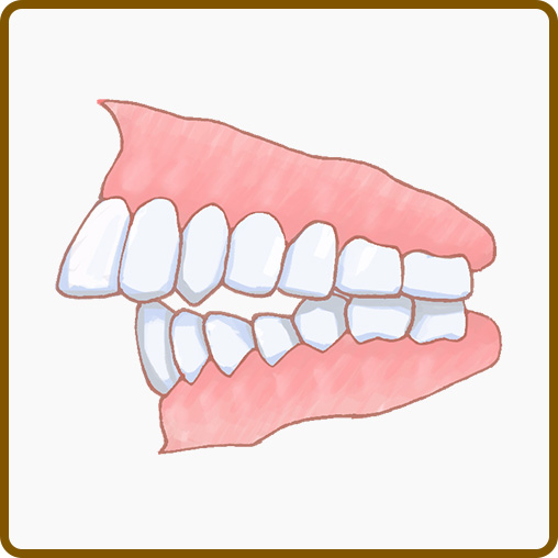 出っ歯(上顎前突)