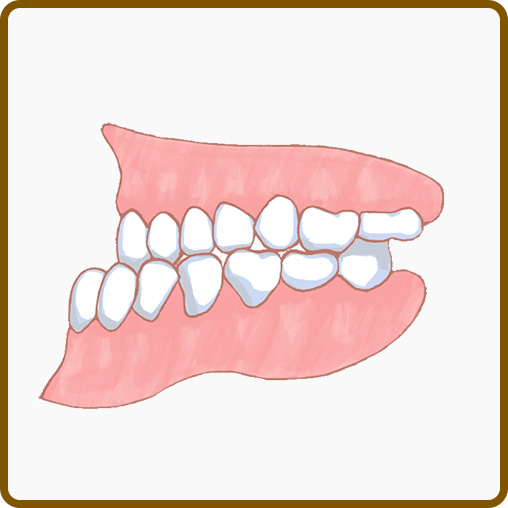 受け口(下顎前突、反対咬合)