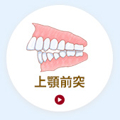 上顎前突