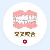 交叉咬合