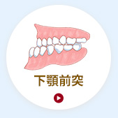 下顎前突