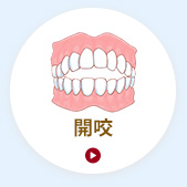 開咬