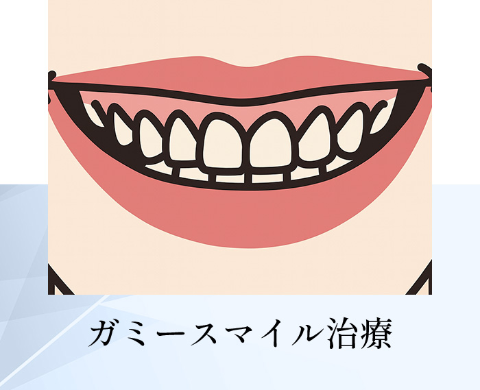 ガミースマイル治療