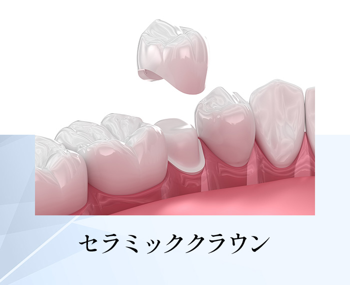 セラミッククラウン