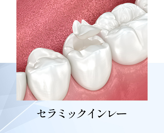 セラミックインレー