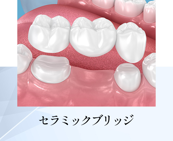 セラミックブリッジ