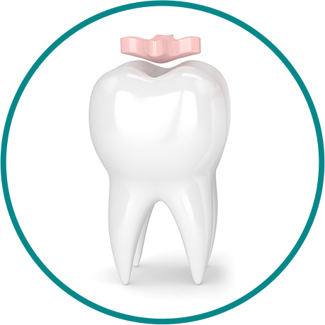 インレー（部分的に歯をおぎなう詰め物）