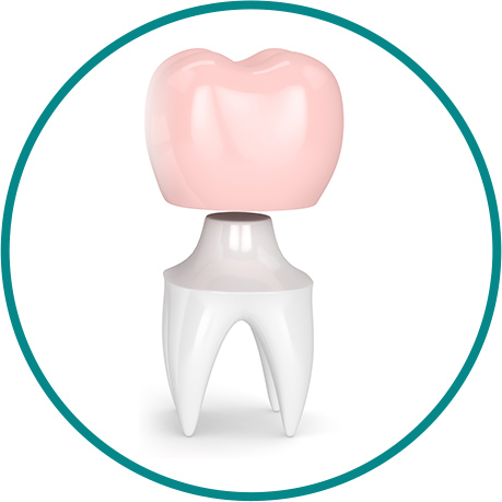 クラウン（かぶせ物）