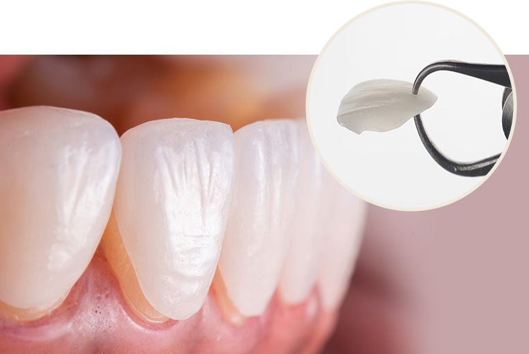 ラミネートベニア