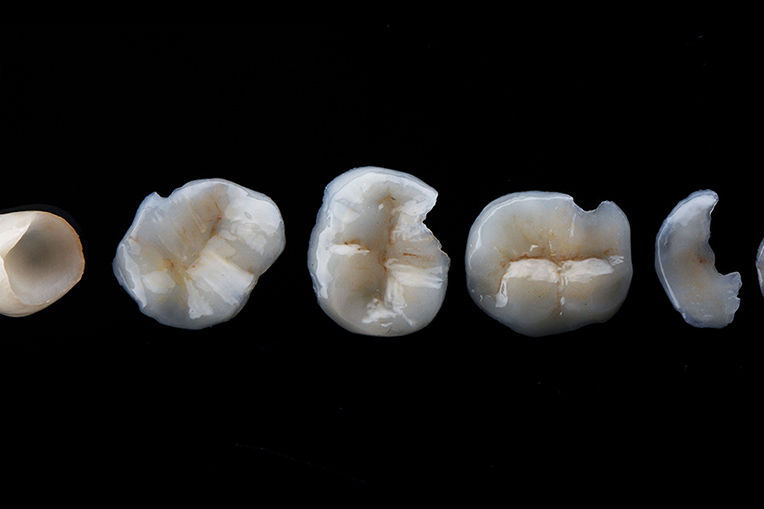 インレー（部分的に歯をおぎなう詰め物）